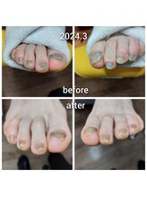 爪切り屋 足楽/肥厚爪も