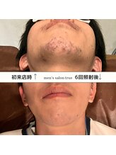 トゥルー(true)/ヒゲ脱毛　6回照射写真☆