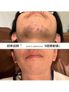 トゥルー(true)/ヒゲ脱毛　6回照射写真☆