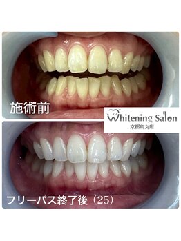 ホワイトニングサロン 京都烏丸店/ホワイトニング施術例