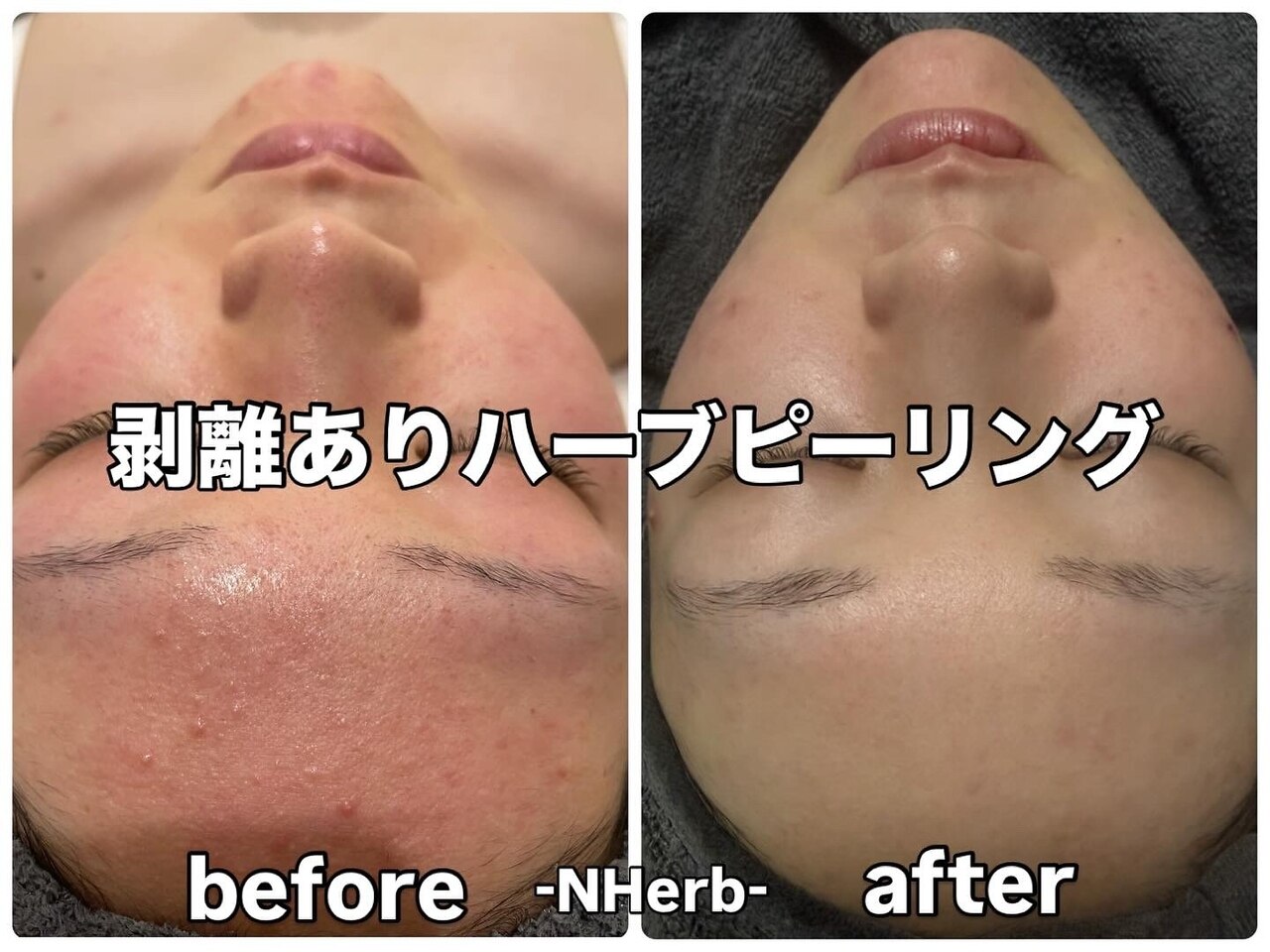 エヌハーブ(NHerb)｜ホットペッパービューティー