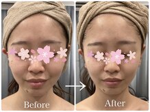 エニ 恵比寿(eni)/【小顔リンパ】ビフォーアフター