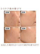 モイラ(MOIRA)/シミケア後の様子