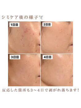 モイラ(MOIRA)/シミケア後の様子