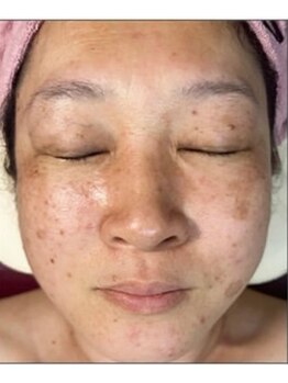 リベル 名古屋(Lebelle:)/ハーブピーリング 名古屋