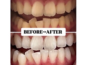 ホワイトニングサロン 豊中/Before&After美白ホワイトニング