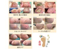 巻き爪補正店 赤羽店