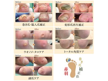 巻き爪補正店 赤羽店