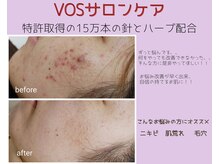 アンティクイーン(Antiqueen)の雰囲気（【VOSサロンケア】肌荒れ改善だけでなく栄養も与え肌質から改善）