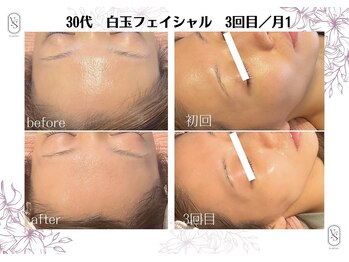 ヴィーナス(Venus)の写真/韓国ピーリング【白玉スキン】ニキビ,シミ,シワ 脂性肌,乾燥肌,敏感肌など、あらゆるお肌をノーフェンデに!