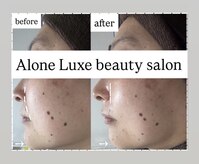アローネリュクス(Alone Luxe)