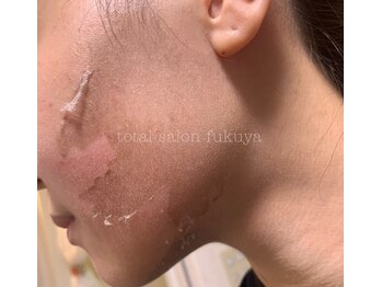 福屋。 指宿店/リベルハーブピーリング