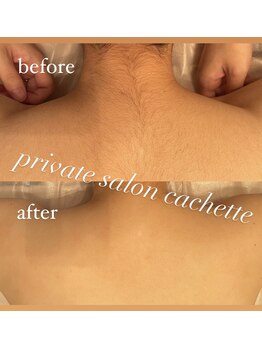 カシェット(cachette)/背中脱毛