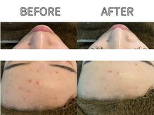 ライム バイ アネラ 高崎(LIME By Anela)/ハーブピーリング/肌質改善