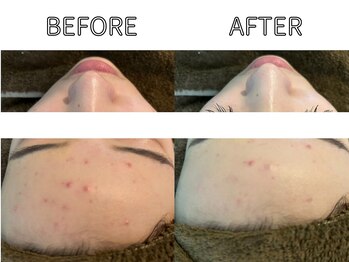 ライム バイ アネラ 高崎(LIME By Anela)/ハーブピーリング/肌質改善