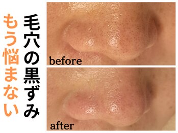 エリン(ERIN)/毛穴徹底洗浄