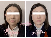 アシュネ(Axiune)/50代★小顔矯正”左右差改善”