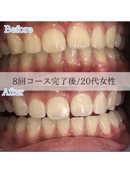 ホワイトニングカフェ 藤が丘店(WhiteningCafe)/8回コース完了後☆