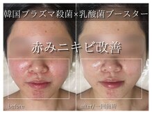 ラ ドゥーサ(La Dusa)/韓国プラズマ×乳酸菌ブースター