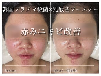 ラ ドゥーサ(La Dusa)/韓国プラズマ×乳酸菌ブースター