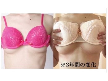 ビサンテ(Vi sante)/下胸変化