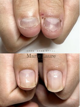 マリーロール 淀屋橋本店(Marie Laure)/自爪育成/深爪矯正/ネイルケア