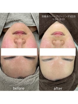 タグ 高知駅前店(Tug)/【頬の赤み・毛穴改善】剥離