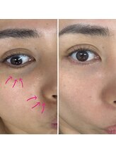 ベル(Belle)/ララピール（ピーリング）