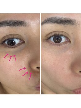 ベル(Belle)/ララピール（ピーリング）