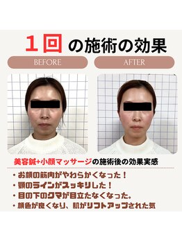 クローバー鍼灸整骨院/美容鍼＋小顔矯正マッサージ　