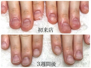 グレースレディ 大阪店/(深爪/長さだし/フィルイン)