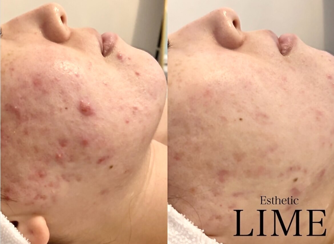 ライム 川崎(LIME)｜ホットペッパービューティー