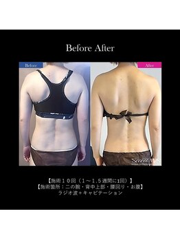 ドルチェビューティーサロン 戸塚安行店(Dolce Beauty Salon)/痩身（上半身）_施術10回