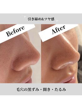 エムビューティーサロン(M Beauty Salon)の写真/毛穴洗浄で角栓・黒ずみケア！ざらつき知らずの韓国肌へ♪当日6600円クーポンあり！ニキビ/毛穴洗浄/小顔