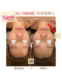 フォルチェ 春日(Folche)/メンズフェイシャル☆