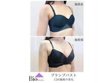 バイオビューティー 神戸本店(Bio Beauty)/プランプバスト　12回コース症例