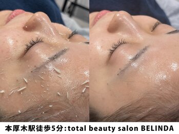 ベリンダ(BELINDA)/セルマンピーリング