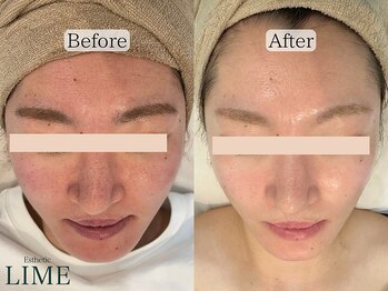 ライム 五反田(LIME)/ハーブピーリング×毛穴洗浄