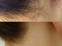 アステキ(ASUTEKI)/成人式の着物姿に!うなじwax脱毛