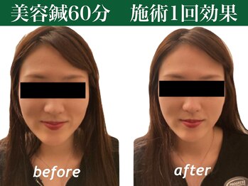 もみの木鍼灸整骨院 恵比寿/中顔面を短縮し理想の卵型へ