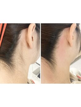 顔脱毛がしたい