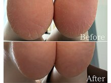 カシェット 広島店(Cachette)/30代女性☆足裏角質ケア90分