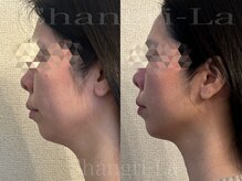 シャングリラ(Shangri-La)/横顔も劇的変化