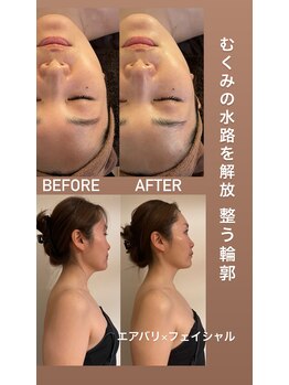 アンミー(anmiiy)/30代エアバリ変化/フェイシャル