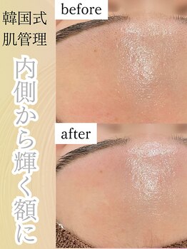 ホワイトラボ 堺東(White labo)の写真/【艶肌爆誕】艶肌ワックスで黒ずみや角質、産毛をごっそり！美容成分高配合で敏感肌の方も安心◎￥5,500