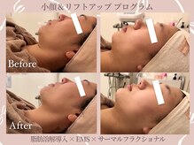 メゾンリュバン 天王寺(Maison Ruban)の雰囲気（脂肪×筋肉×コラーゲン層にトリプルアプローチ◎）