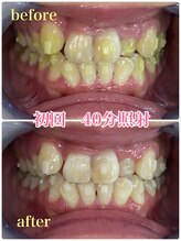 プラチナムビューティー 川口駅前店(PLATINUM BEAUTY)/歯科矯正中もホワイトニング可能