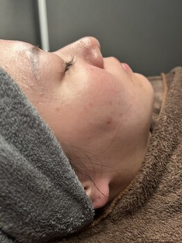 スムー かほく店(Smoo)の写真/肌のターンオーバーを正常化へ導き、お肌の毛穴悩みを根本から改善♪理想の透明感へ！