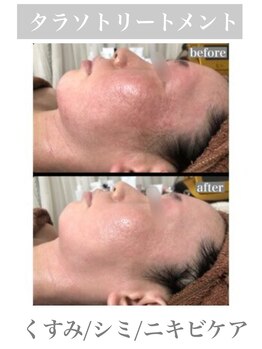 アカアカ(aka'aka)/タラソトリートメント