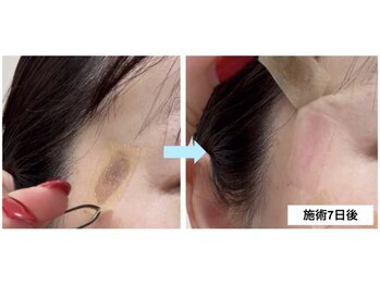 シミケア高松/シミが改善！？【事例紹介】